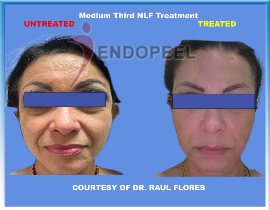 naso labial furrow- Dr Raul Flores