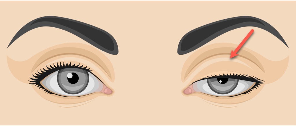 upper-eyelid-lift-endopeel