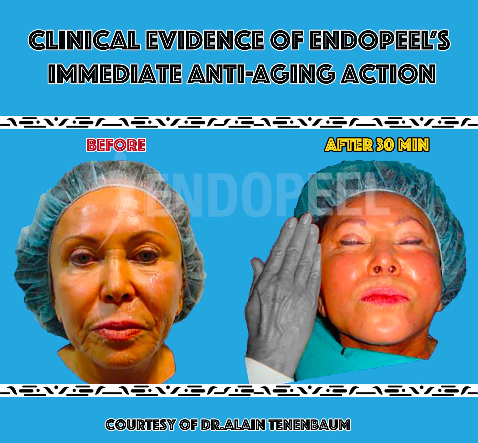 immediate-facecontour-endopeel-vs-hands