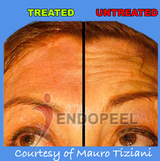 forehead-wrinkles-endopeel-1-clinic
