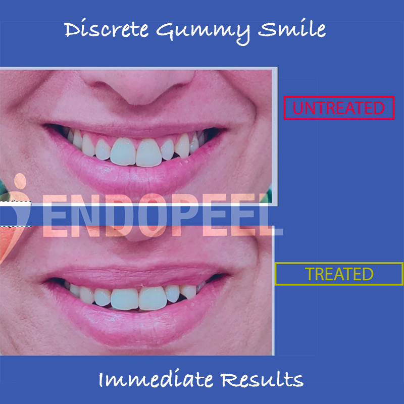 discrete-gummy-smile