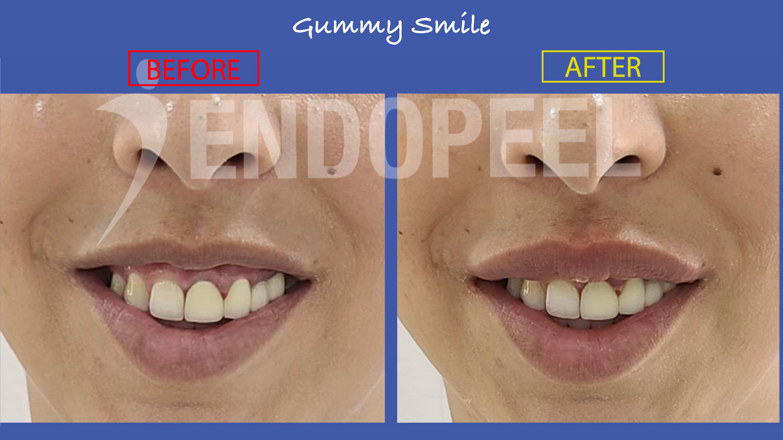 gummy-smile-1600x900