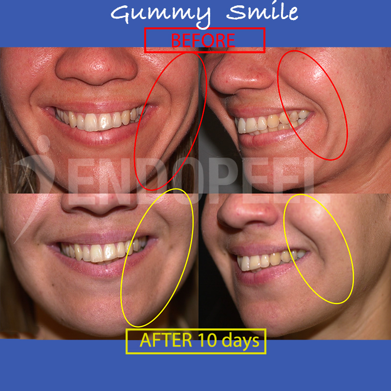 gummy-smile-d10-front-profile