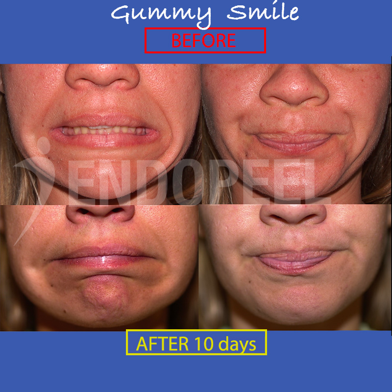 gummy-smile-d10-front