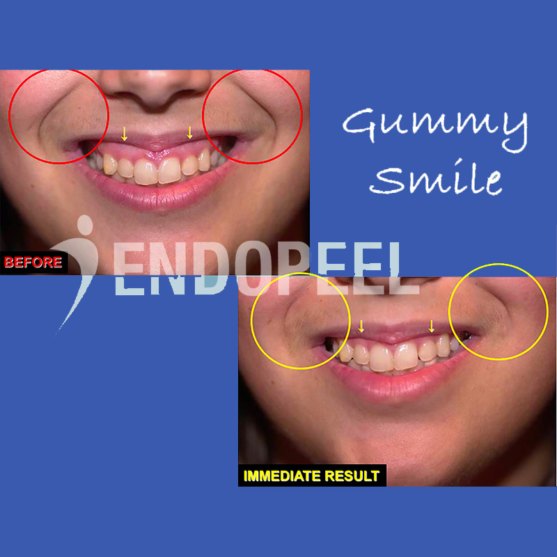 gummy-smile2-immediate