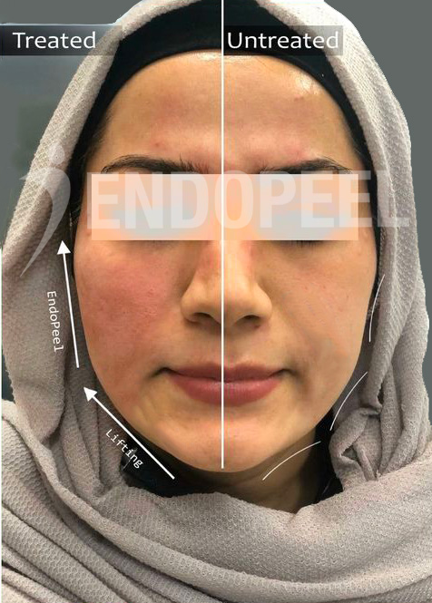 middle eastern female middle and lower third of the face