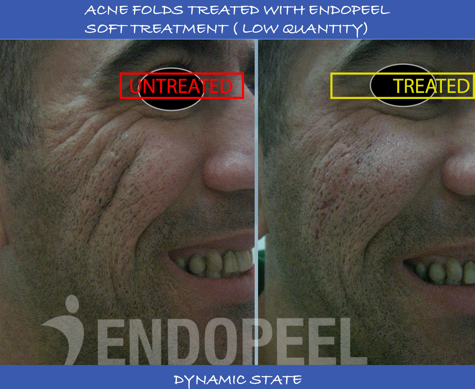 acne-folds-dynamic-