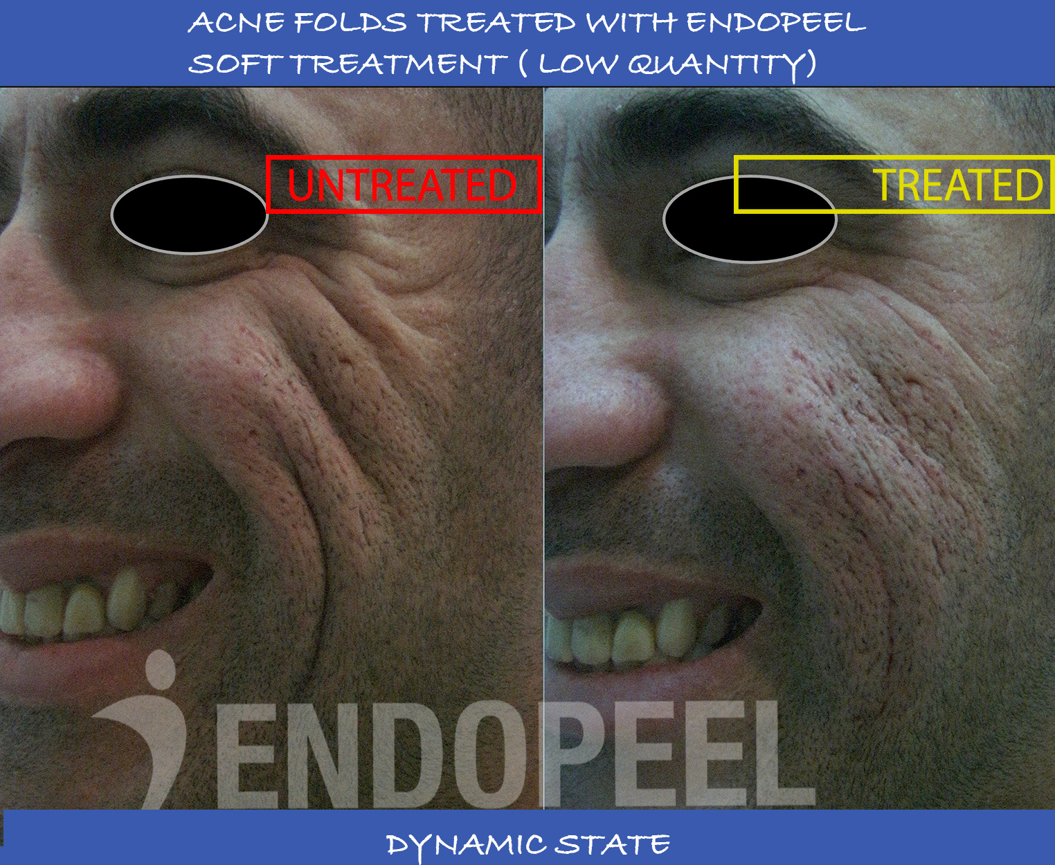 acne-folds-dynamic-soft-endopeel