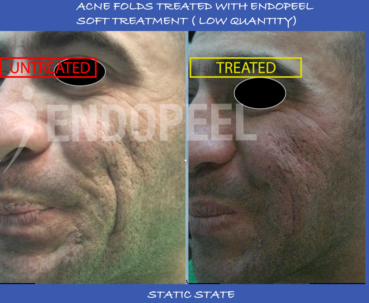 acne-folds-static-soft-endopeel