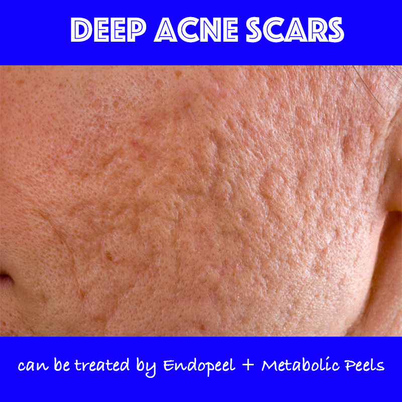 deep acne scars