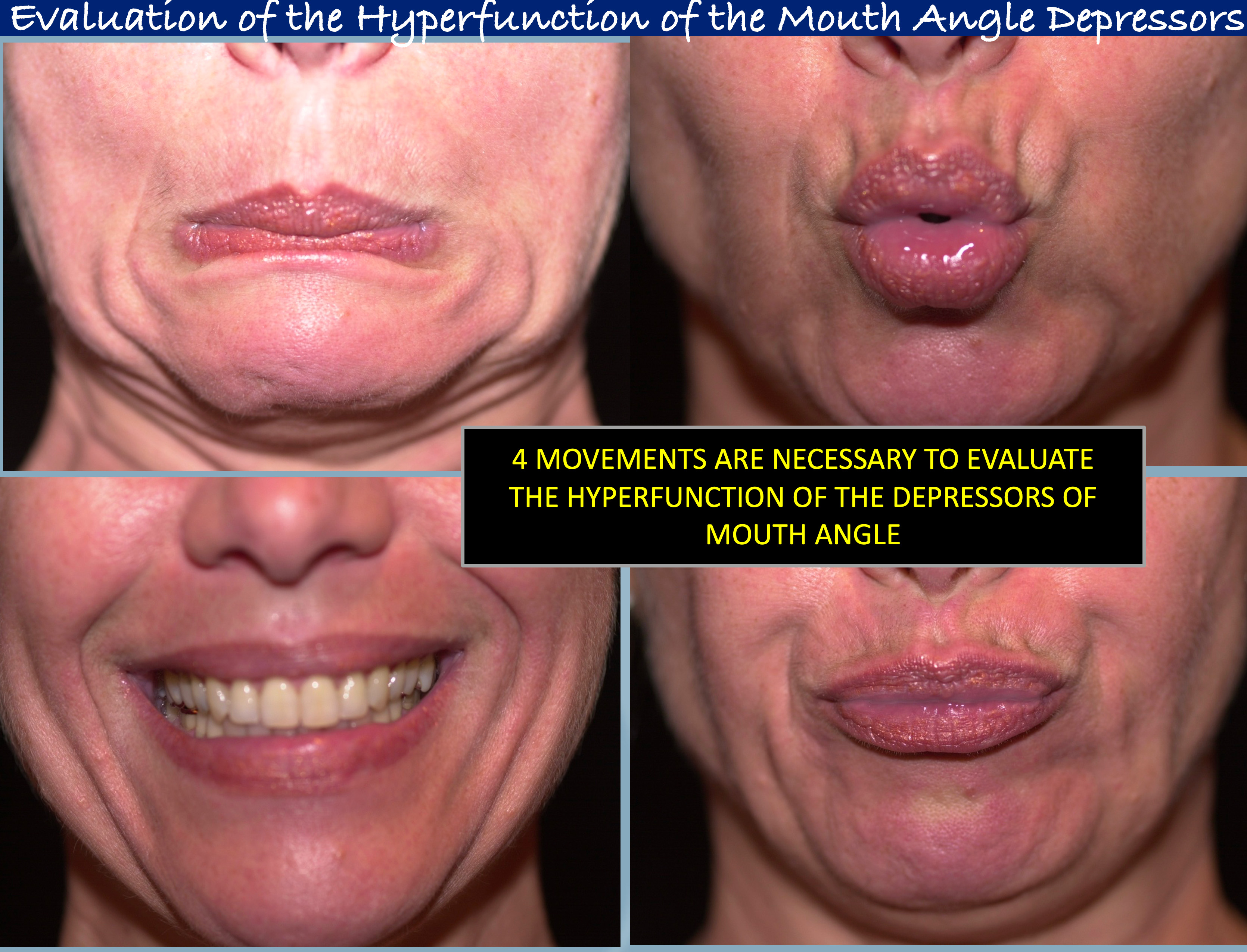 evaluation--mouth-angle2