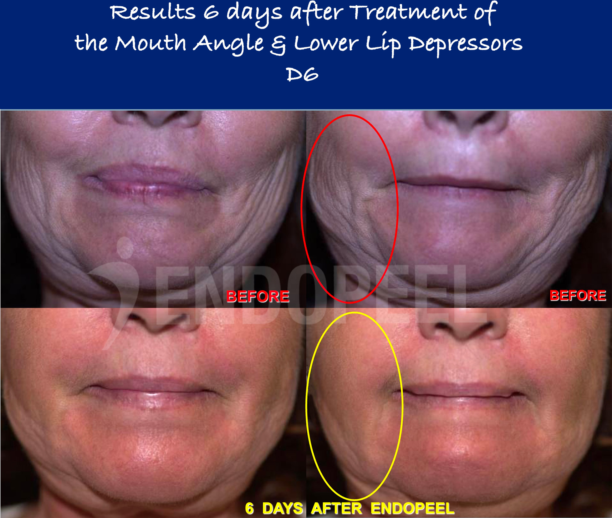 lower-lip-depressors-D6