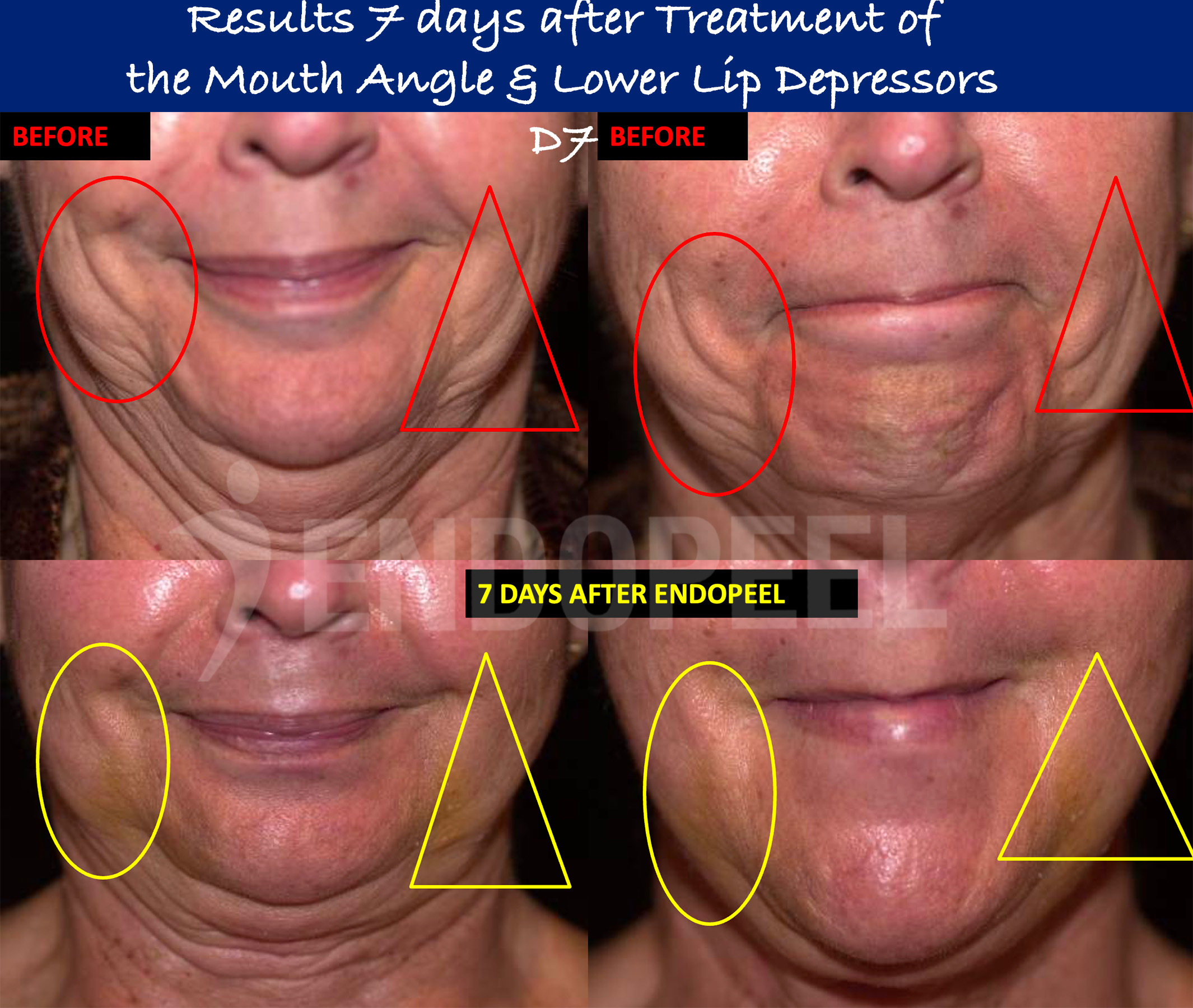 lower-lip-depressors-D7-v2