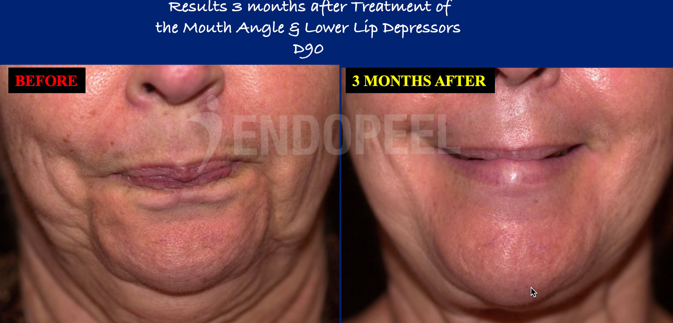 lower-lip-depressors-D90