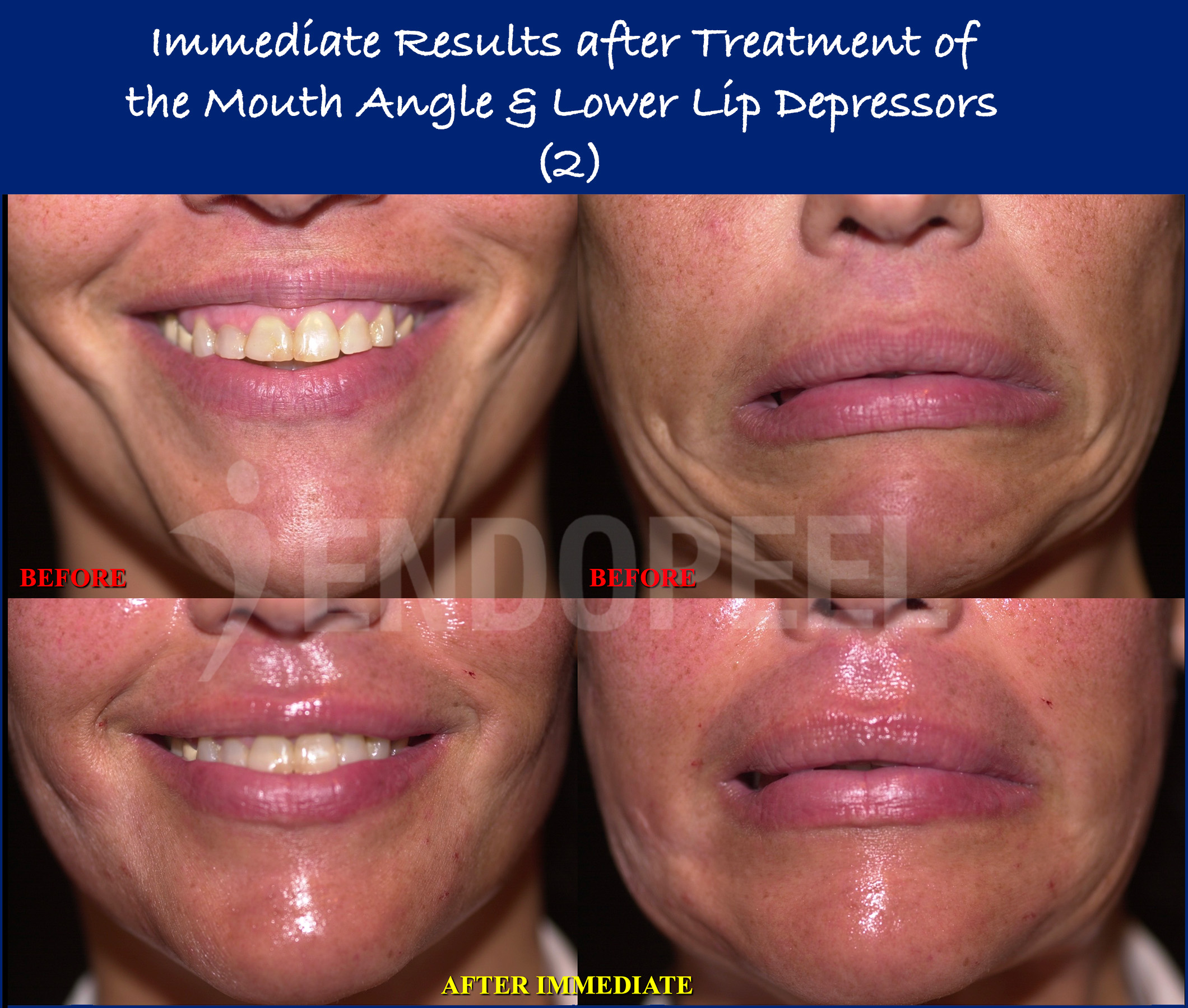 lower-lip-depressors-results-2