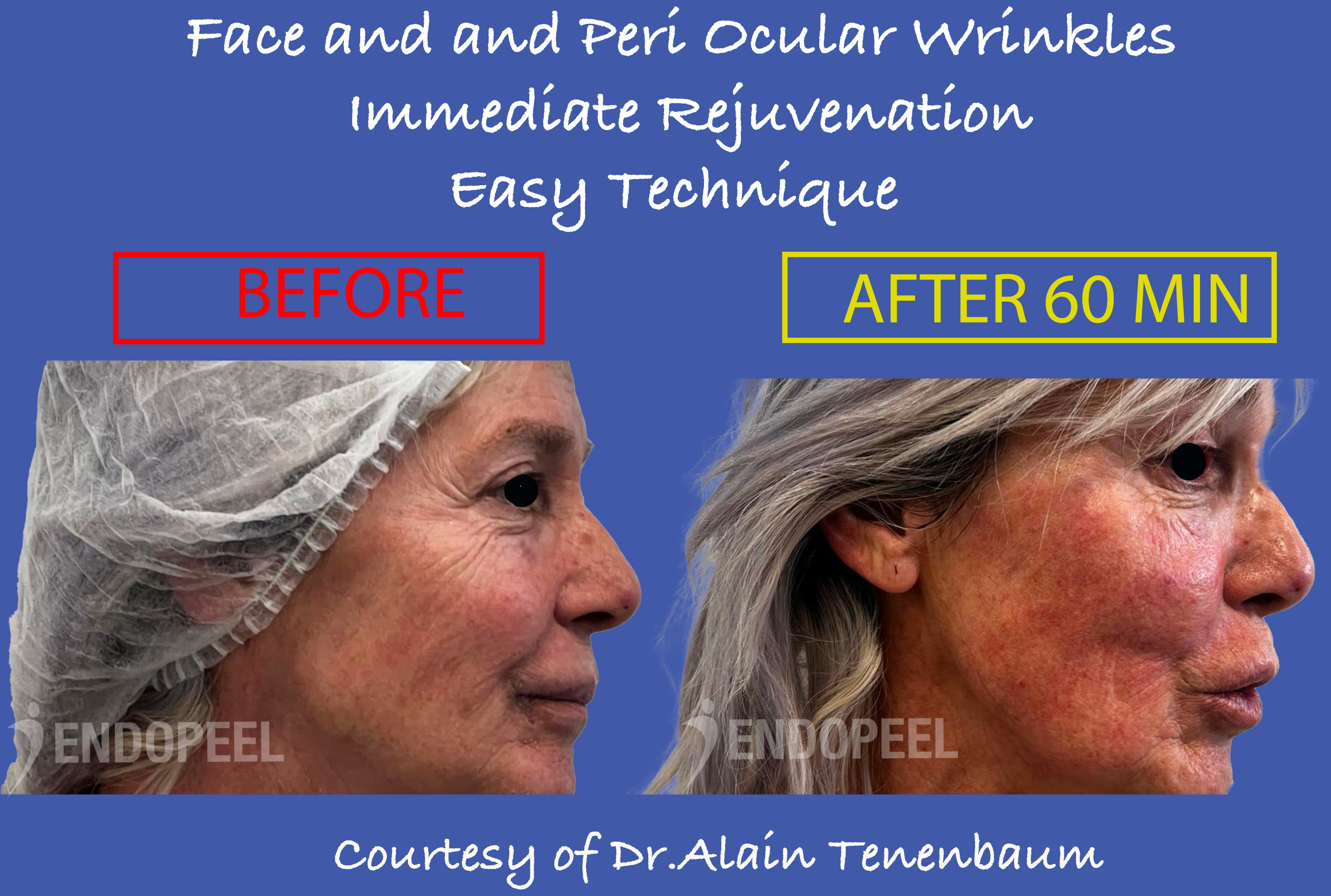 Periocular Wrinkles treated with Endopeel + Peeling de Luxe + 30 min Peel Off