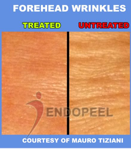 macroscopy-forehead-wrinkles-endopeel