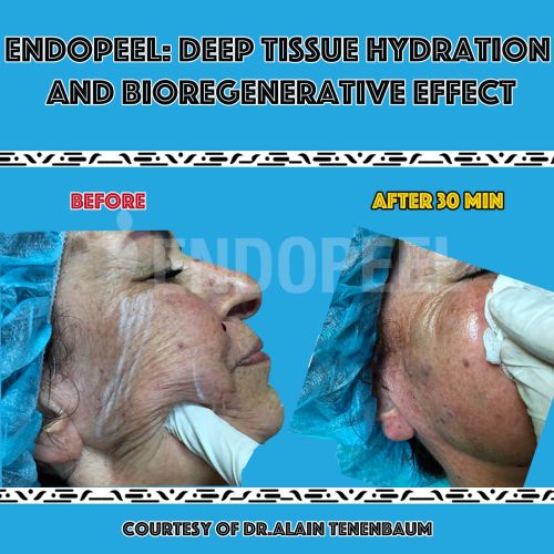 hydration-bioregenerative-endopeel