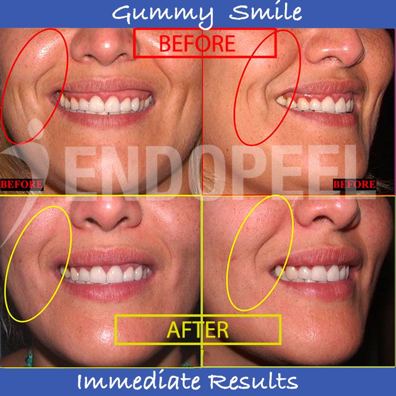 gummy-smile-front-profile