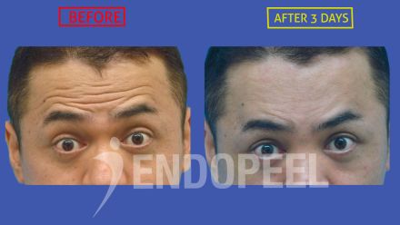 male-forehead-wrinkles-endopeel