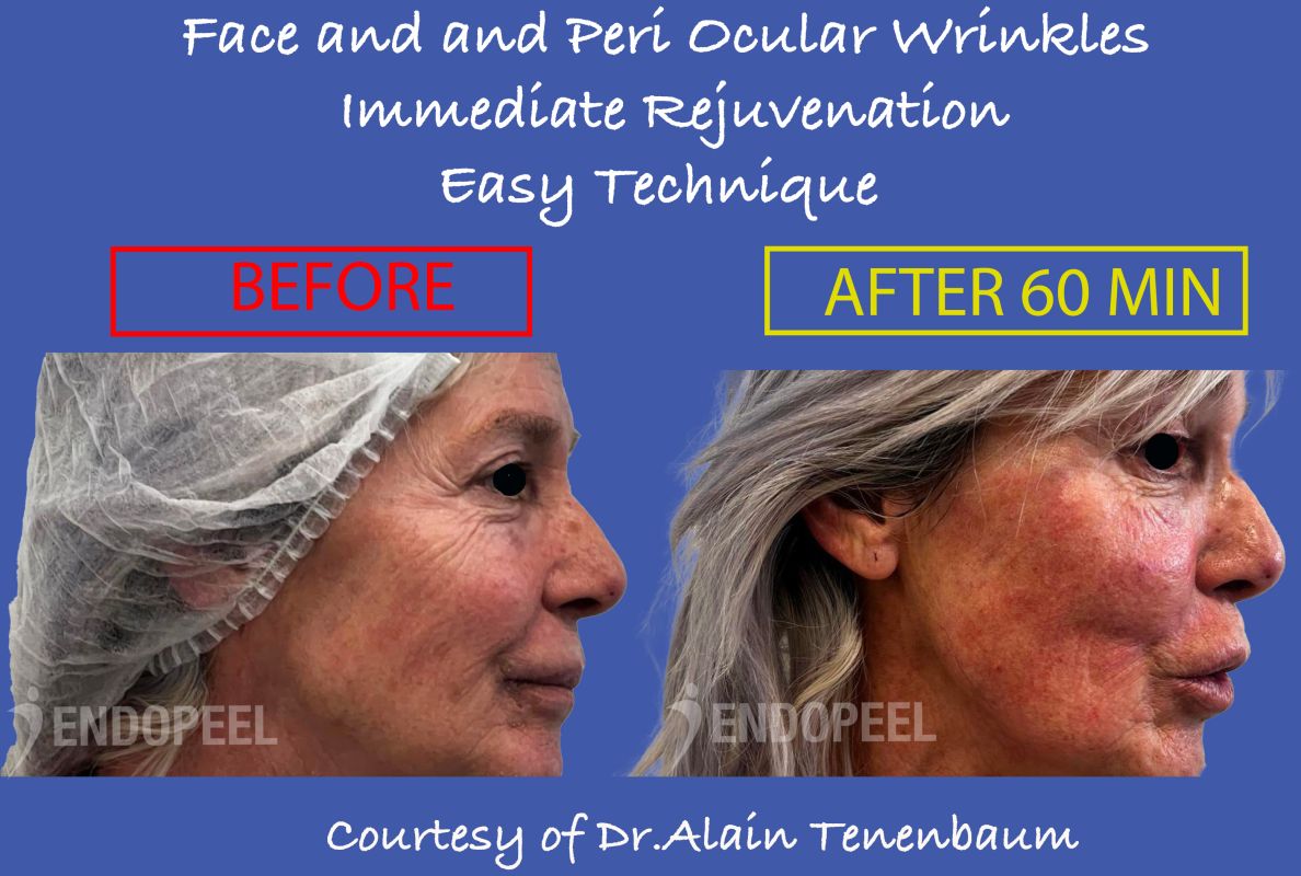 periocular-wrinkles-endopeel