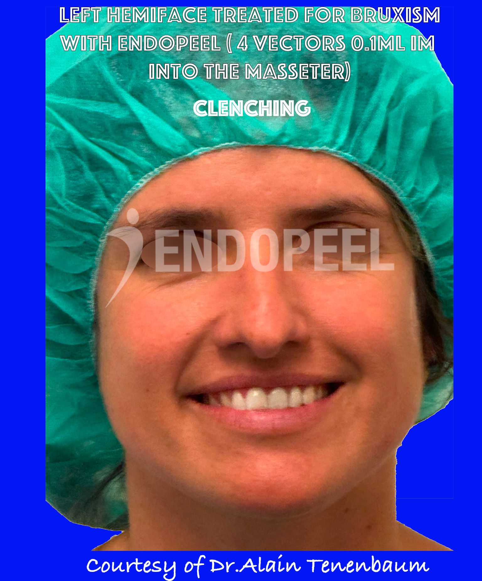 bruxism-clenching