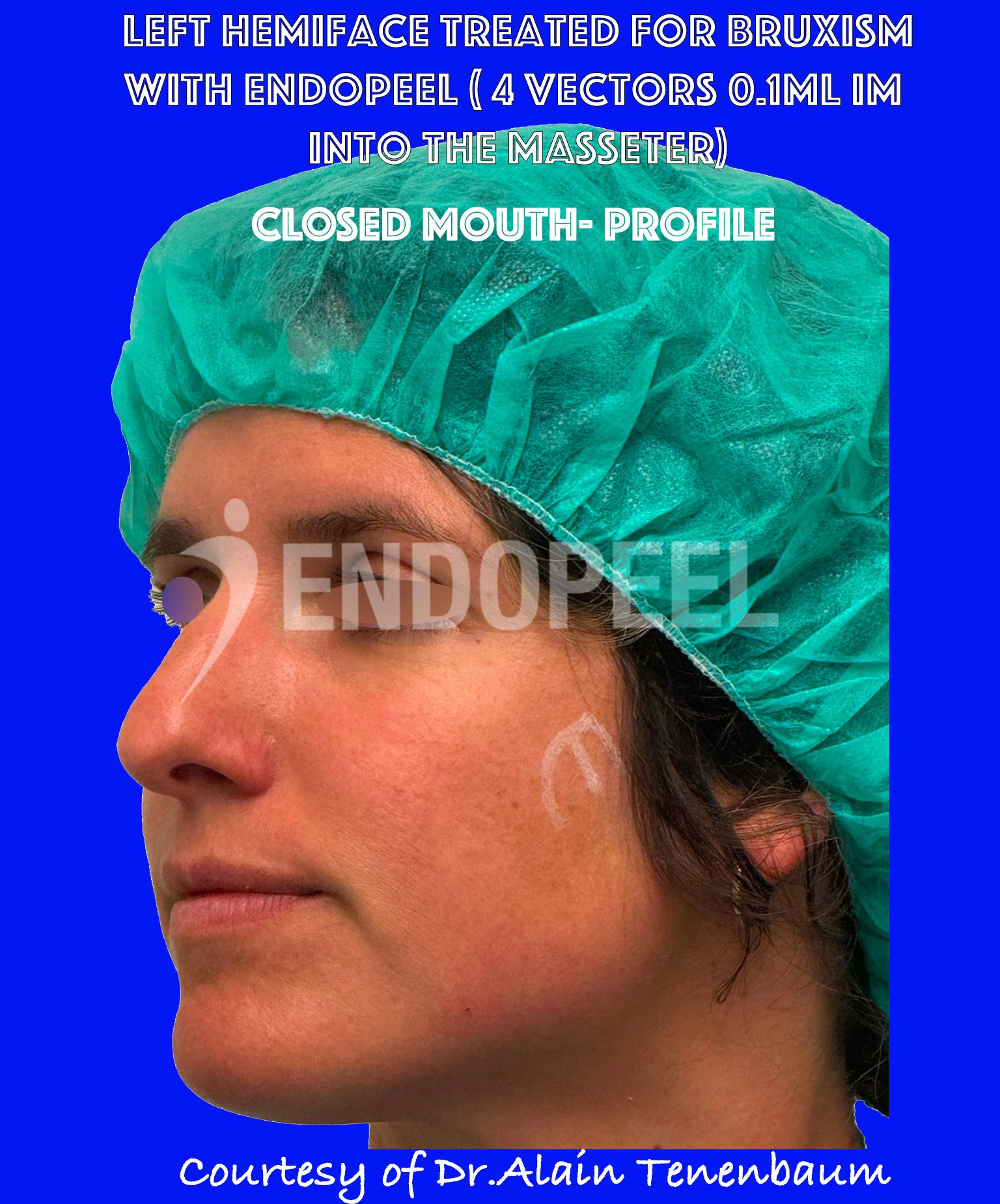 bruxism-closed-mouth-profile