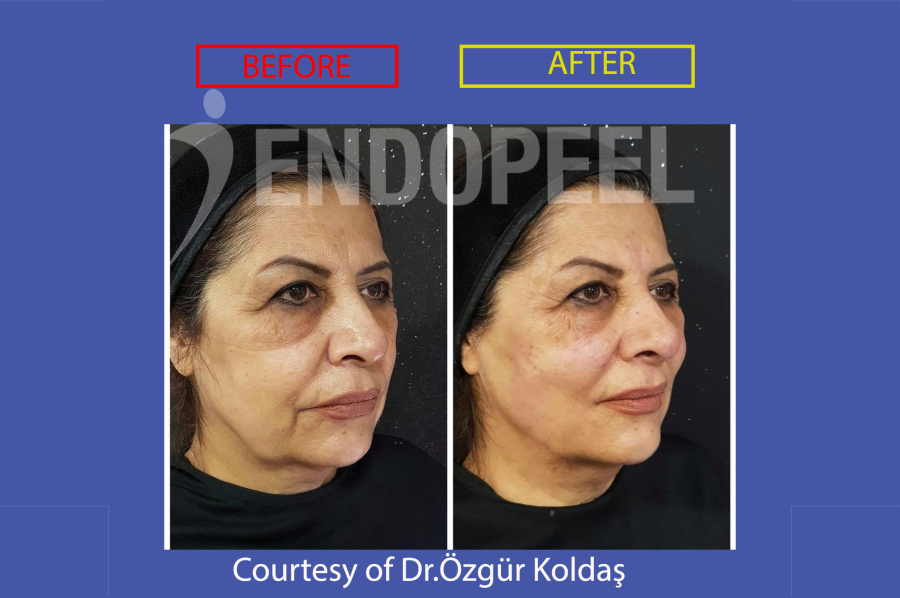 Full face Endopeel + partial filler HA