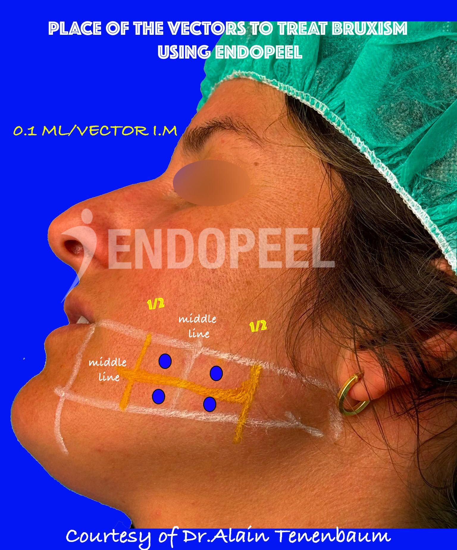 bruxism endopeel vectors on a patient