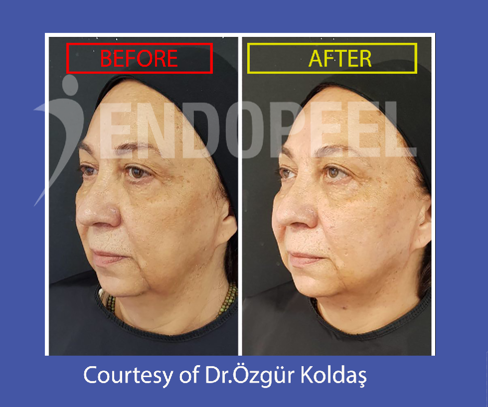 facial tightening endopeel and anti aging