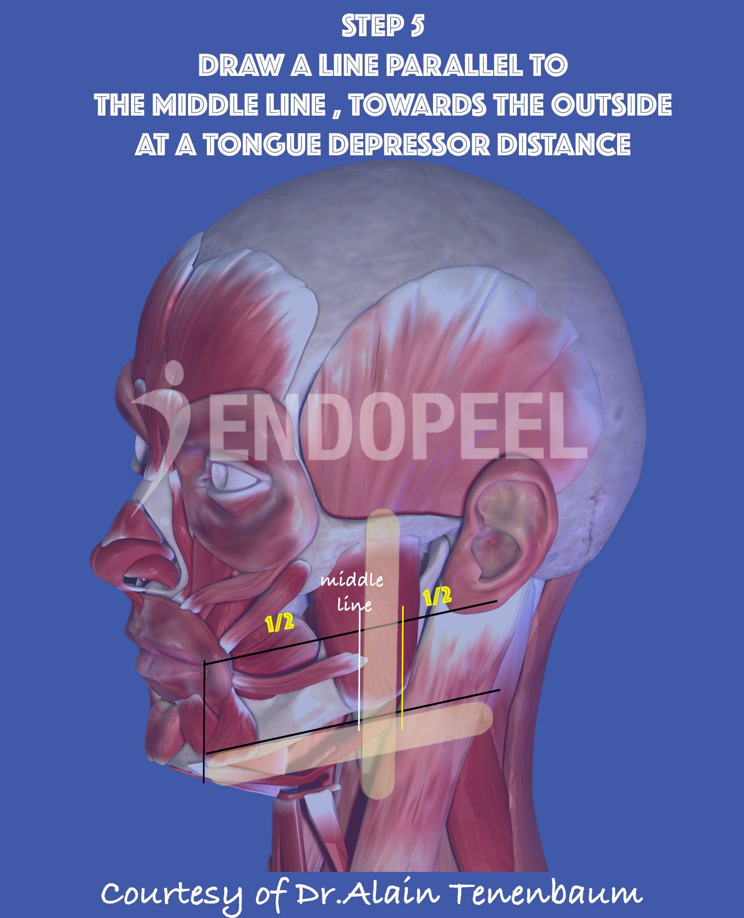 1 tongue depressor towards outside  from  the middle line