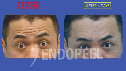 male-forehead-wrinkles-endopeel