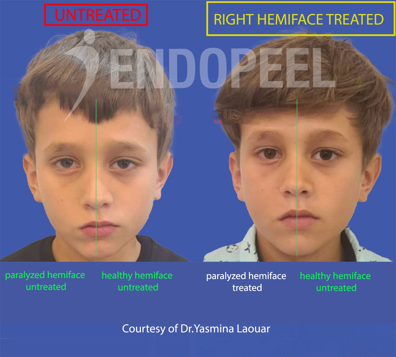 PF-child-endopeel-without-mimicry-nosmile