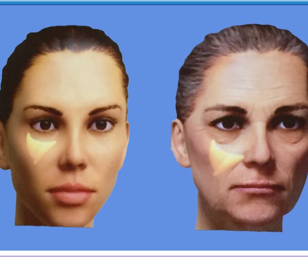 Modification of Axis & Ptosis of the Malar Fat Pad 2