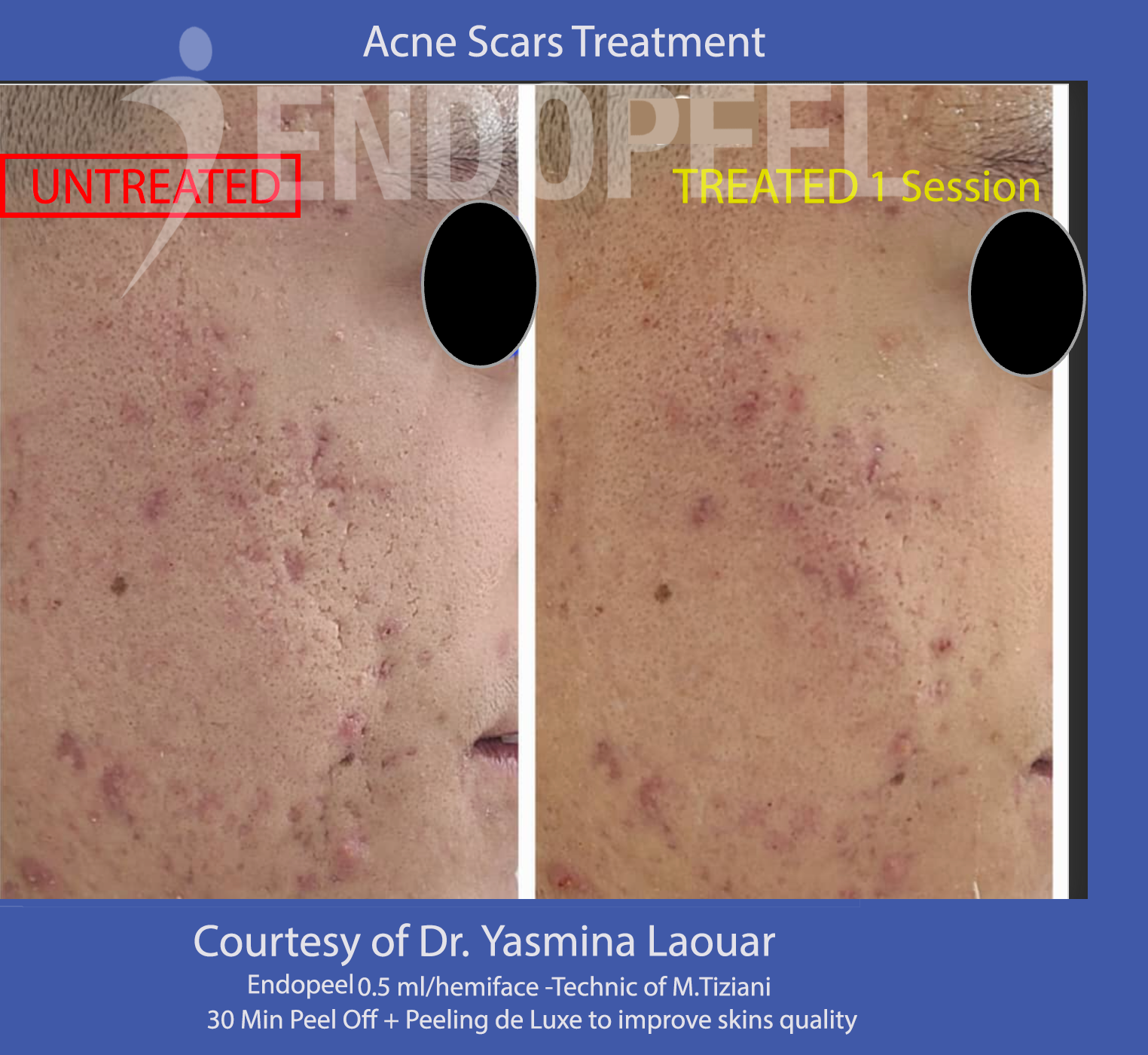 acne-scars-yasmina-laouar-right-side