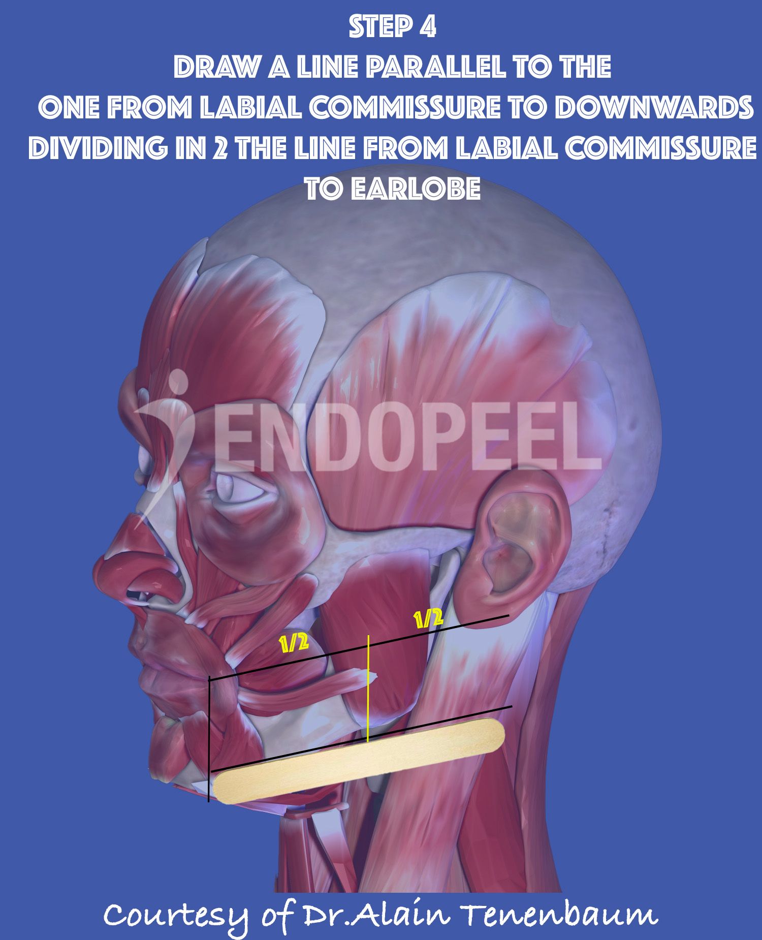 divide in 2 the line from labial commissure to ear lobe with a vertical
