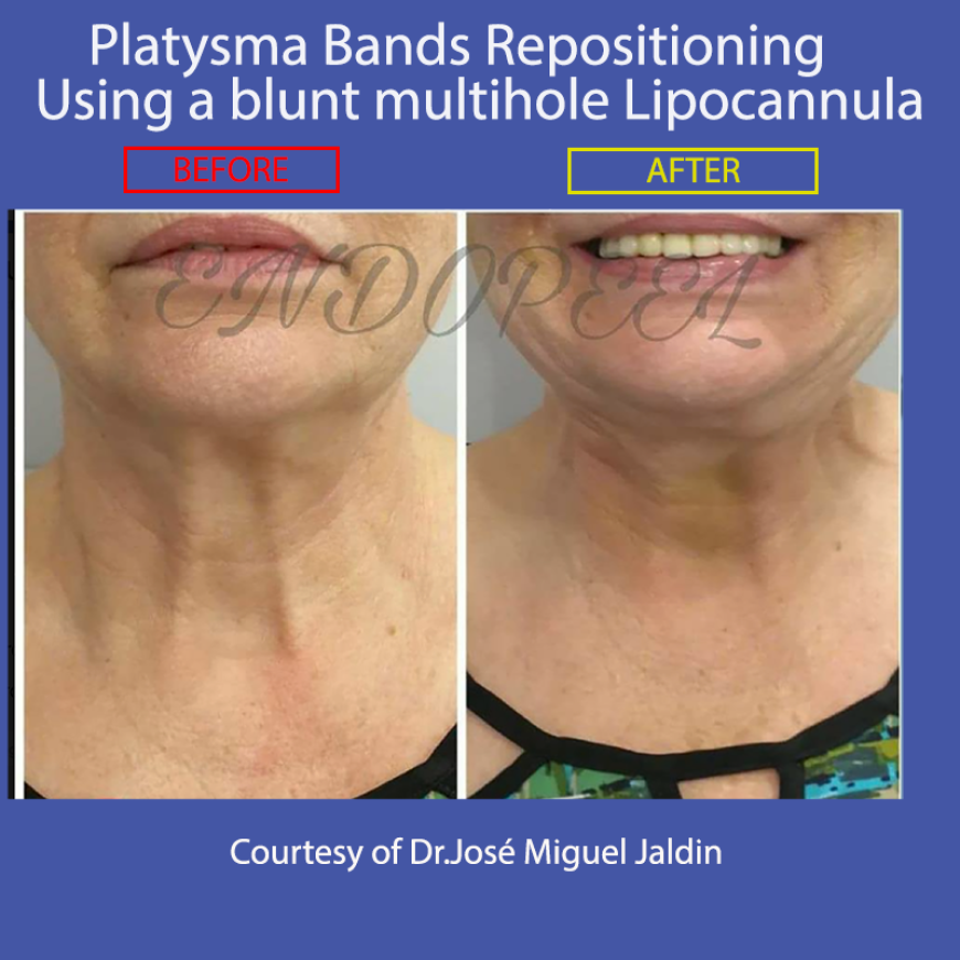 platysma repositioning with endopeel lipocanula