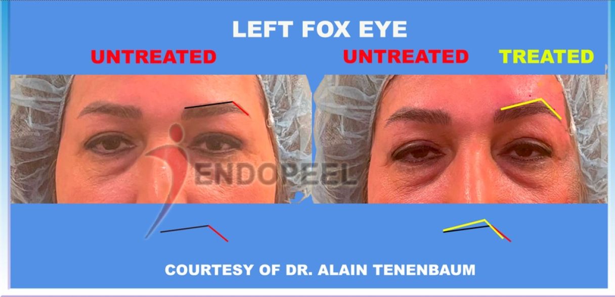 brow angle female left fox eye