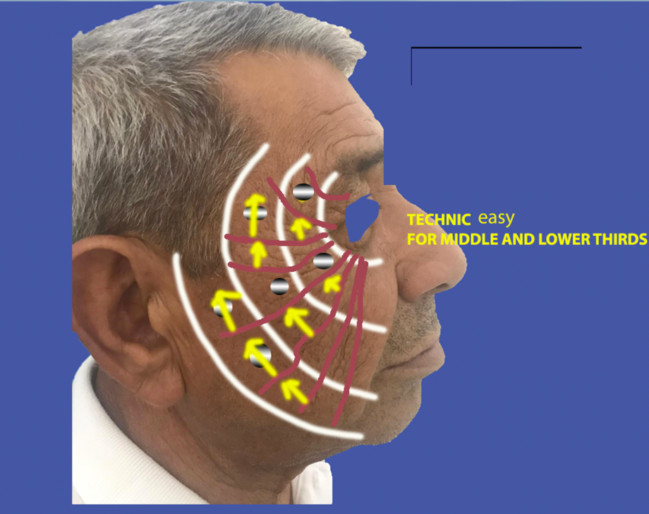 step 5 easy technic face endopeel