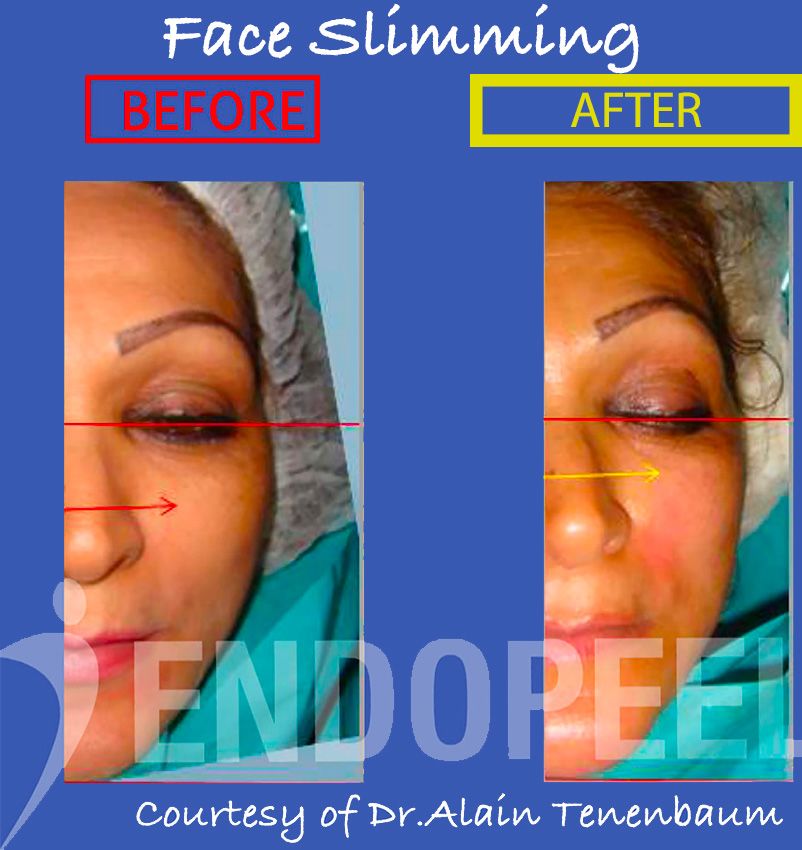 face-slimming