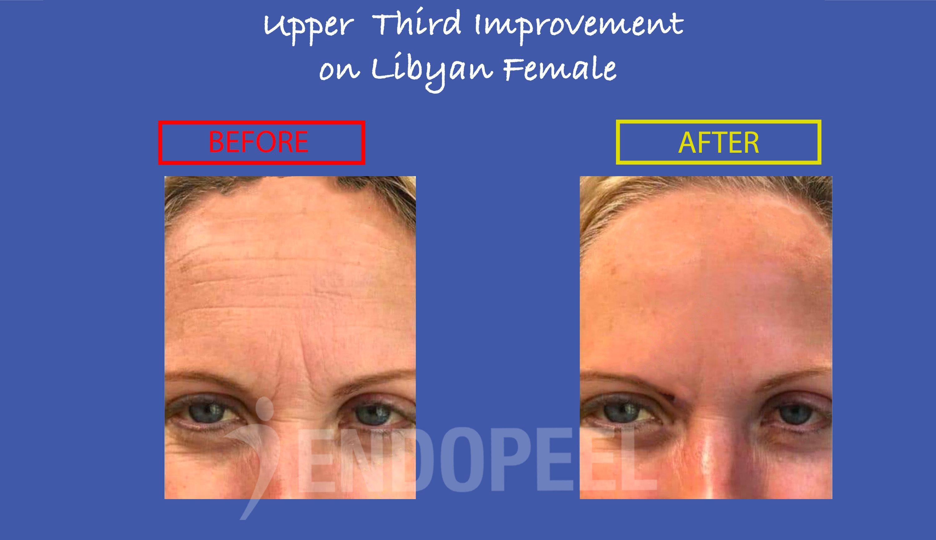 libyan-forehead-female