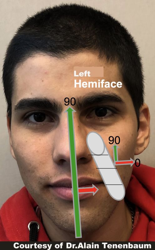 NLF  L HEMIFACE step 1 Gonzalito