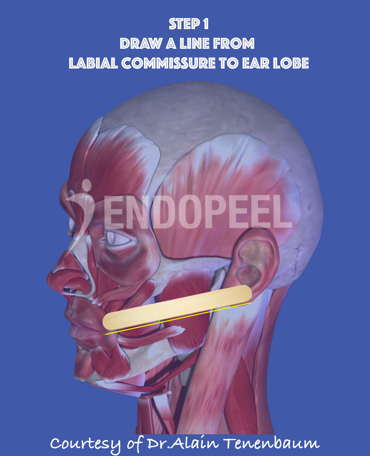 line from labial commissure to ear lobe