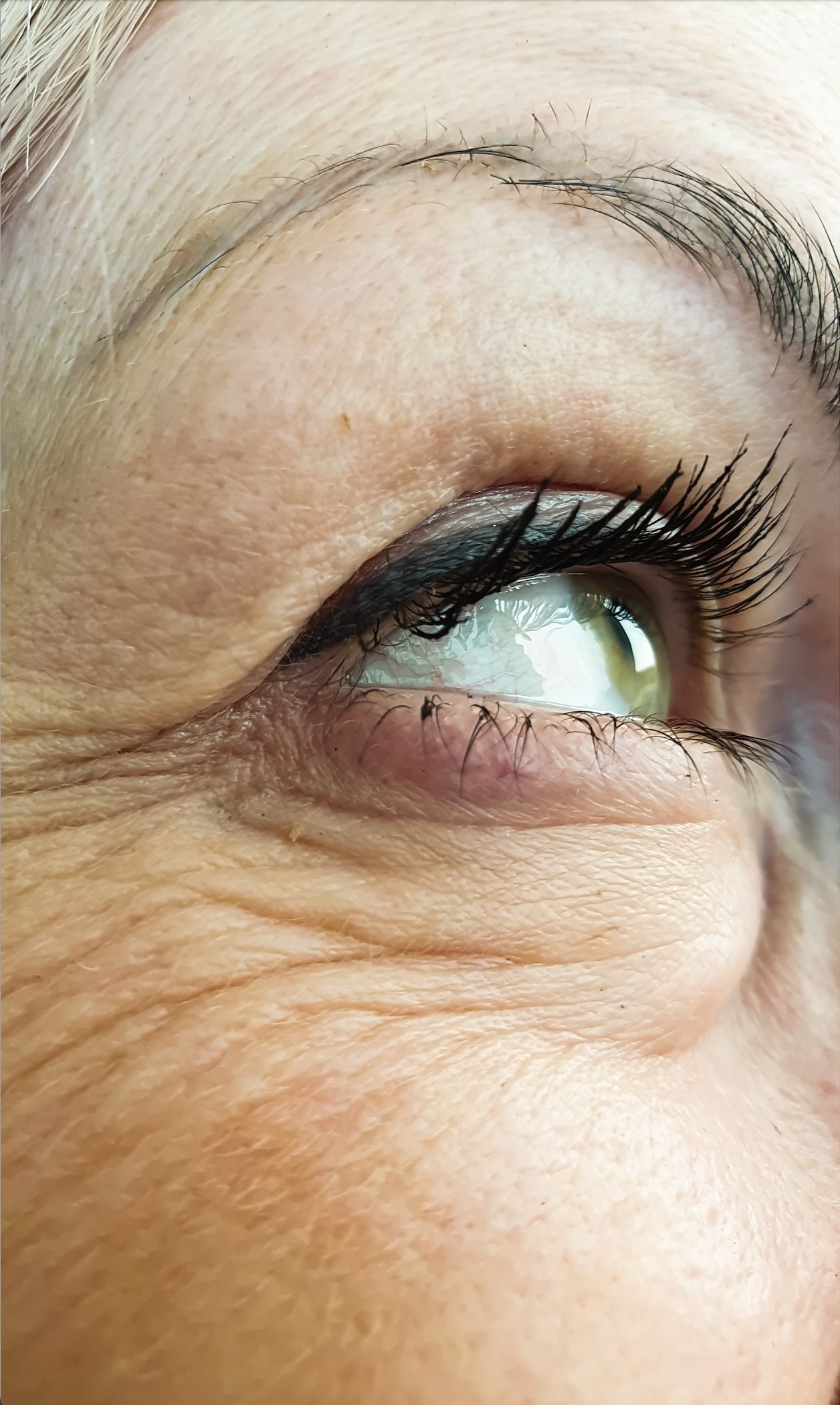 lower-eyelid-fat-herniae