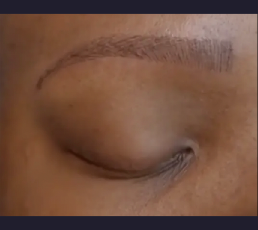 hairless eyebrow corrected by tatoo