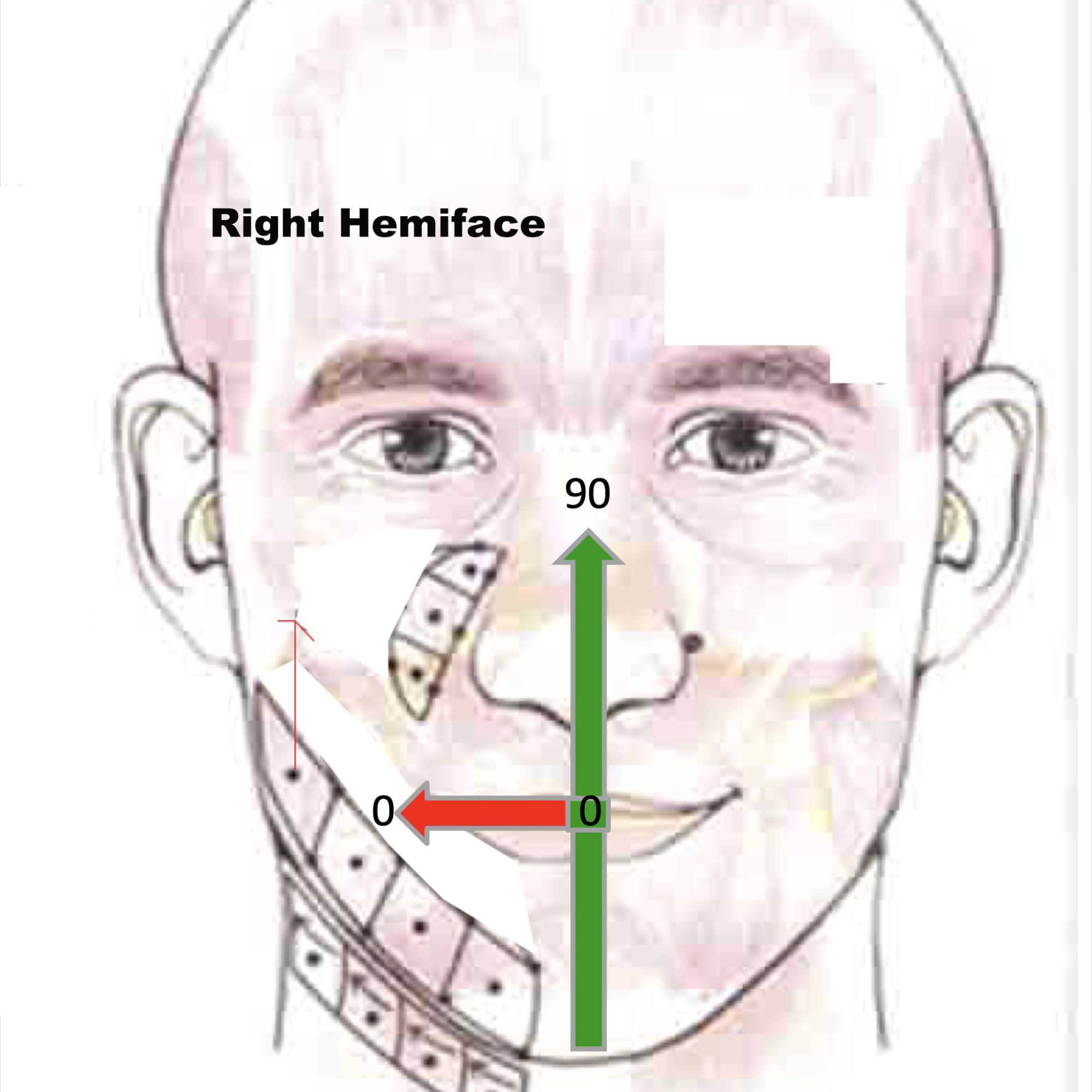 summary R Hemiface