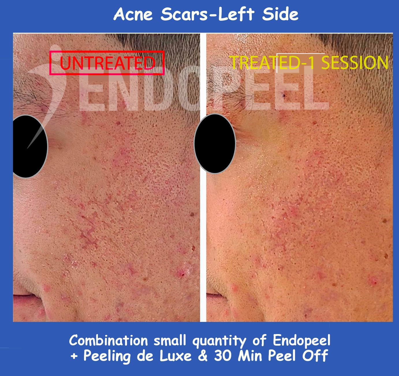 acne scars combination left side