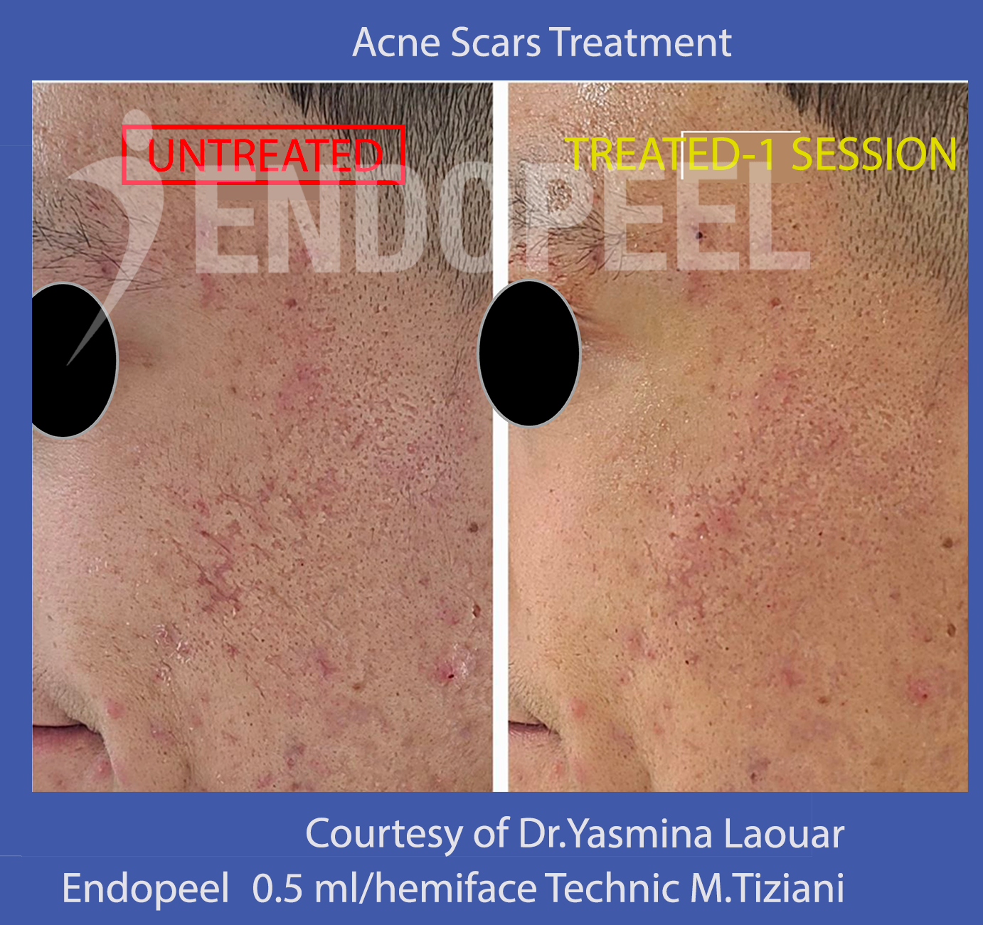 acne-scars-yasmina-laouar