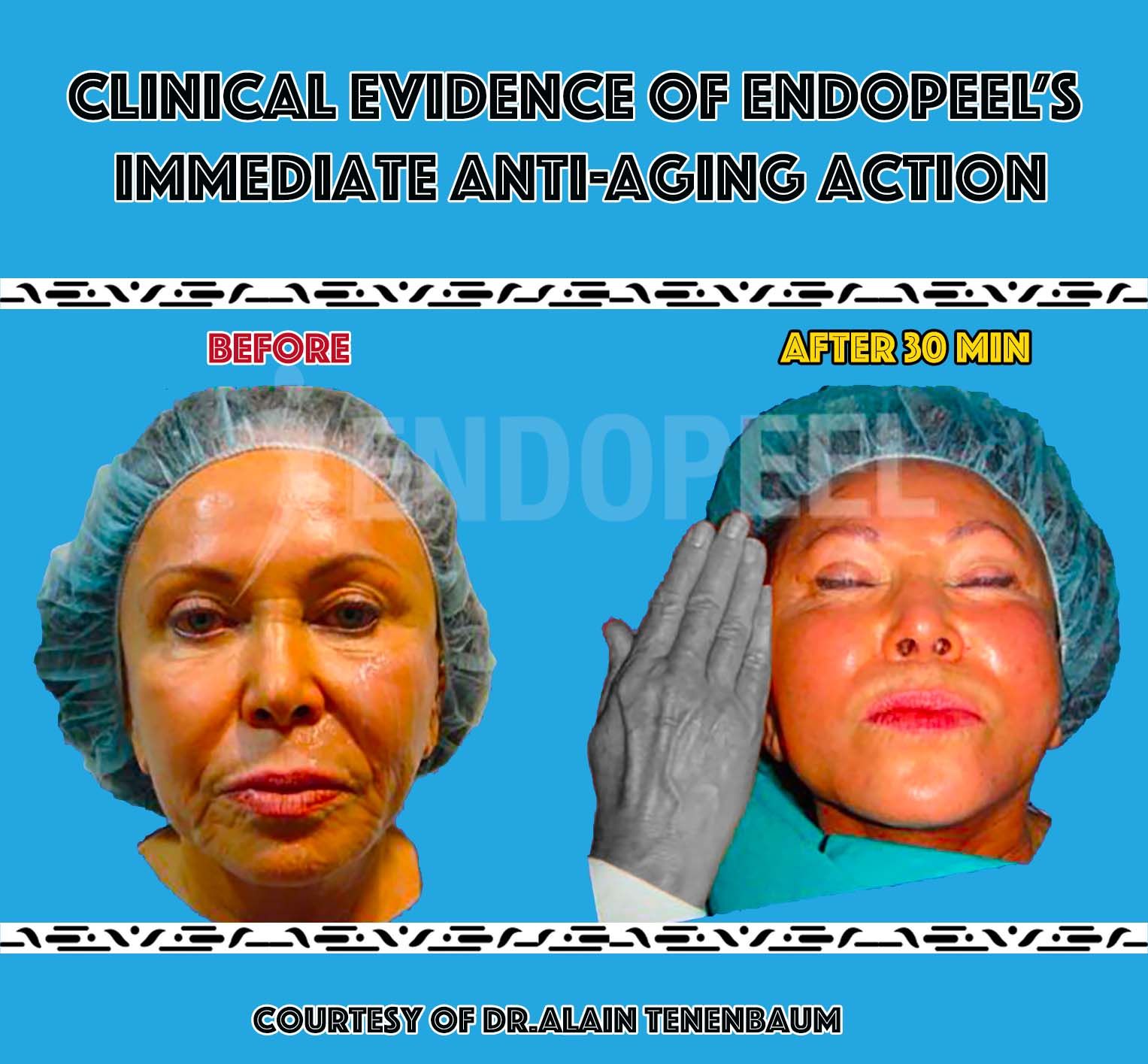 immediate-facecontour-endopeel-vs-hands