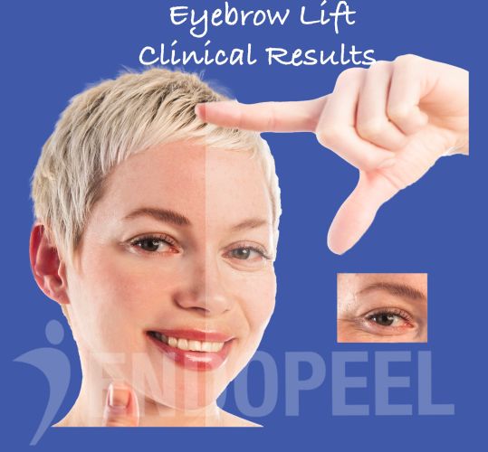 eyebrow-lift-clinical-results-hero